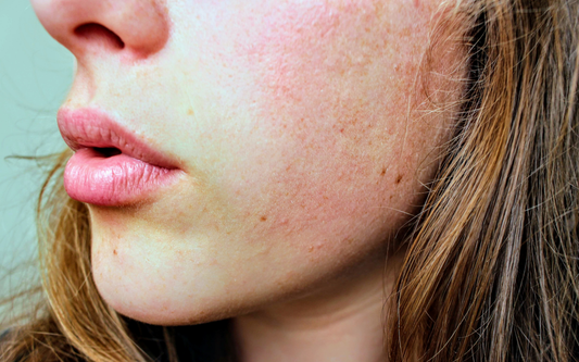 Why Is Your Skin Still Dry After Moisturizing?